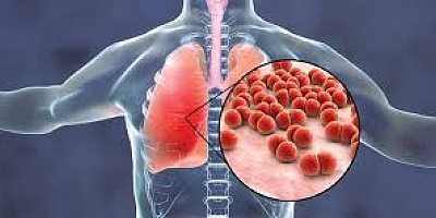 Zatürrenin Erken Belirtilerine Dikkat: Hayati Önemi Var!